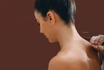 acupuncture in carlsbad
